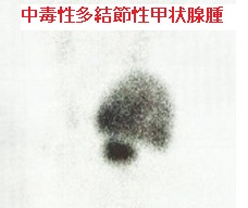 中毒性多結節性甲状腺腫 ヨードシンチグラム(123-I シンチグラフィー) 中毒性多結節性甲状腺腫 ヨードシンチグラム(123-I シンチグラフィー)