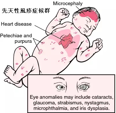 先天性風疹症候群 先天性風疹症候群