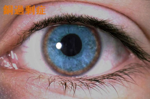 カイザー-フライシャー輪 カイザー-フライシャー輪