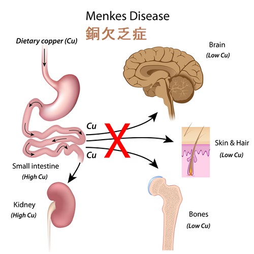 銅欠乏症と甲状腺 銅欠乏症と甲状腺