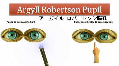 アーガイル ロバートソン瞳孔 アーガイル ロバートソン瞳孔