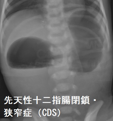 先天性十二指腸閉鎖・狭窄症(CDS) 先天性十二指腸閉鎖・狭窄症(CDS)