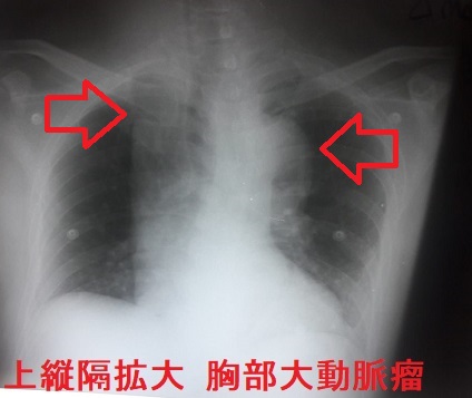 上縦隔拡大 胸部大動脈瘤 上縦隔拡大 胸部大動脈瘤