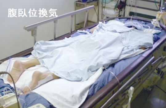 腹臥位換気 急性呼吸窮迫(こきゅうひっぱく)症候群(ARDS) 腹臥位換気 急性呼吸窮迫(こきゅうひっぱく)症候群(ARDS)