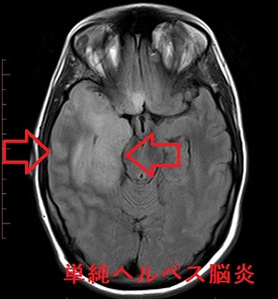 単純ヘルペス脳炎 MRI FLAIR画像 単純ヘルペス脳炎 MRI FLAIR画像