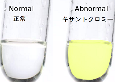 髄液検査;キサントクロミー 髄液検査;キサントクロミー