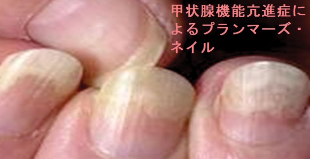 甲状腺機能亢進症によるプランマーズ・ネイル 甲状腺機能亢進症によるプランマーズ・ネイル