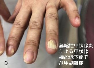 萎縮性甲状腺炎による甲状腺機能低下症で爪甲剥離症 萎縮性甲状腺炎による甲状腺機能低下症で爪甲剥離症