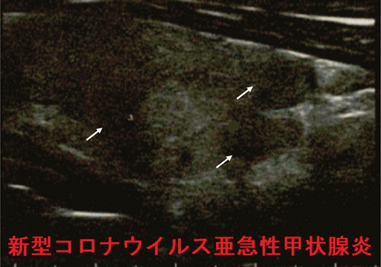 イタリアの新型コロナウイルス亜急性甲状腺炎 イタリアの新型コロナウイルス亜急性甲状腺炎