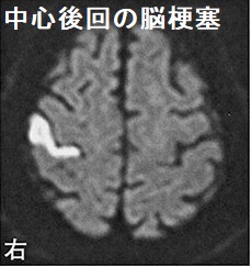 中心後回の脳梗塞 中心後回の脳梗塞