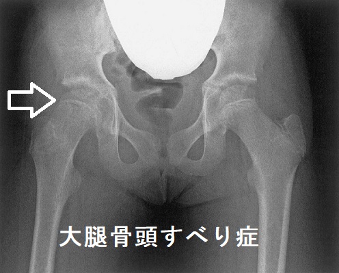 大腿骨頭すべり症 X線写真 大腿骨頭すべり症 X線写真