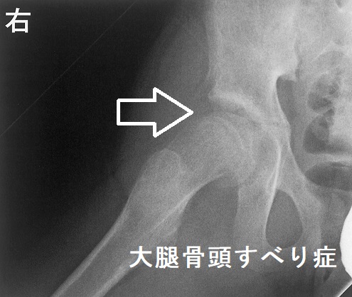 大腿骨頭すべり症 X線写真 大腿骨頭すべり症 X線写真