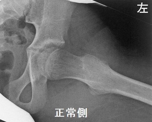 大腿骨頭すべり症 X線写真 大腿骨頭すべり症 X線写真