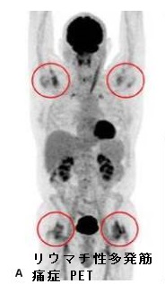 リウマチ性多発筋痛症 pet リウマチ性多発筋痛症 pet