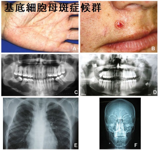 基底細胞母斑症候群 基底細胞母斑症候群