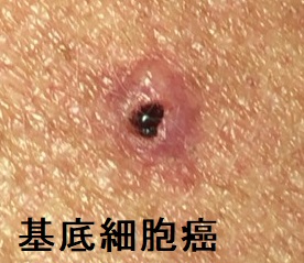 基底細胞癌 基底細胞癌