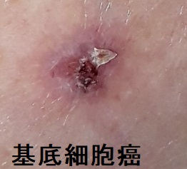 基底細胞癌 基底細胞癌