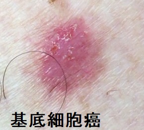 基底細胞癌 基底細胞癌