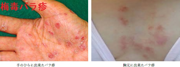 手のひら、胸元の梅毒性ばら疹 手のひら、胸元の梅毒性ばら疹