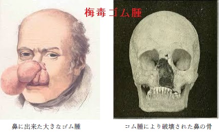 梅毒ゴム腫 梅毒ゴム腫