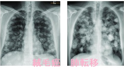 絨毛癌 肺転移 絨毛癌 肺転移