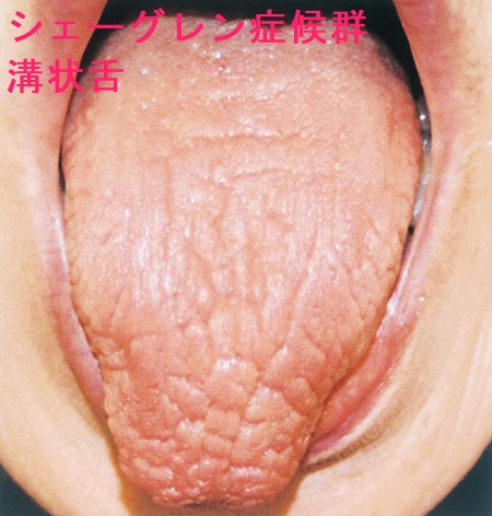シェーグレン症候群 溝状舌 シェーグレン症候群 溝状舌