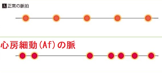 心房細動(Af)の脈 心房細動(Af)の脈