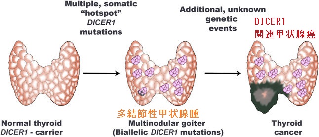 DICER1 関連甲状腺癌 DICER1 関連甲状腺癌