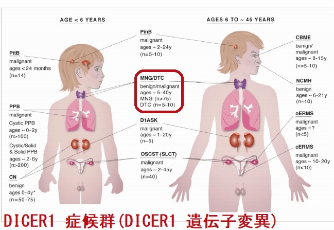 DICER1 症候群(DICER1 遺伝子変異) DICER1 症候群(DICER1 遺伝子変異)