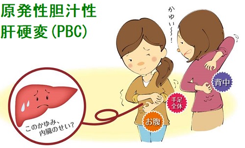 原発性胆汁性肝硬変(PBC) 原発性胆汁性肝硬変(PBC)