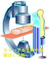 カテーテル手術中の被ばく予防(全国循環器研究会だよりより) カテーテル手術中の被ばく予防(全国循環器研究会だよりより)