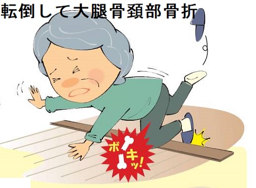 高齢者バセドウ病患者は転倒して大腿骨頚部骨折と大腿骨転子部骨折(脚の付け根の骨折) 高齢者バセドウ病患者は転倒して大腿骨頚部骨折と大腿骨転子部骨折(脚の付け根の骨折)