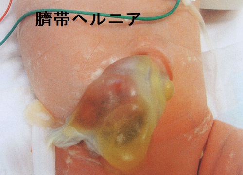 臍帯ヘルニア 臍帯ヘルニア