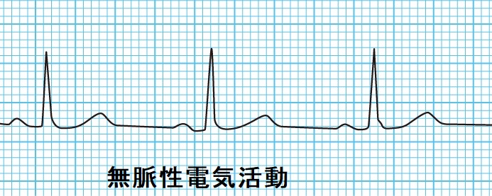 無脈性電気活動 無脈性電気活動