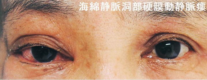 海綿静脈洞部硬膜動静脈瘻 眼球結膜、眼瞼の充血・浮腫 海綿静脈洞部硬膜動静脈瘻 眼球結膜、眼瞼の充血・浮腫