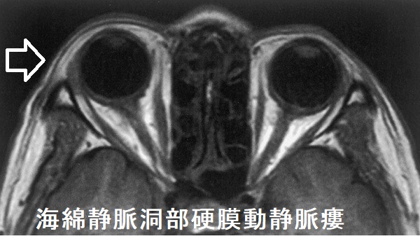 海綿静脈洞部硬膜動静脈瘻 眼窩MRI画像 海綿静脈洞部硬膜動静脈瘻 眼窩MRI画像
