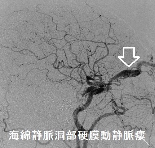 海綿静脈洞部硬膜動静脈瘻 頸動脈造影検査 海綿静脈洞部硬膜動静脈瘻 頸動脈造影検査