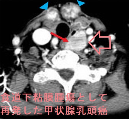 食道下粘膜腫瘍として再発した甲状腺乳頭癌 造影CT画像 食道下粘膜腫瘍として再発した甲状腺乳頭癌 造影CT画像