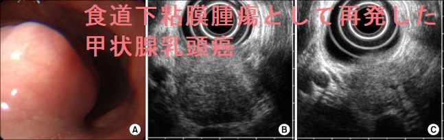 食道下粘膜腫瘍として再発した甲状腺乳頭癌 超音波内視鏡画像 食道下粘膜腫瘍として再発した甲状腺乳頭癌 超音波内視鏡画像