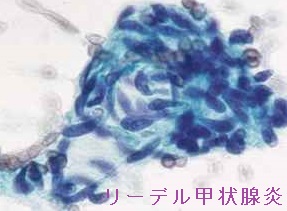 リーデル(Riedel)甲状腺炎 細胞診 リーデル(Riedel)甲状腺炎 細胞診