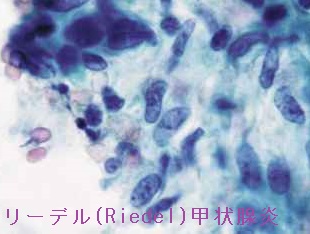 リーデル(Riedel)甲状腺炎 細胞診 リーデル(Riedel)甲状腺炎 細胞診
