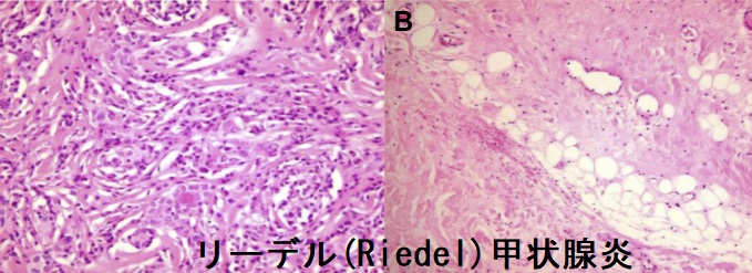 リーデル(Riedel)甲状腺炎 組織像 リーデル(Riedel)甲状腺炎 組織像