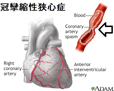 冠攣縮性狭心症 冠攣縮性狭心症