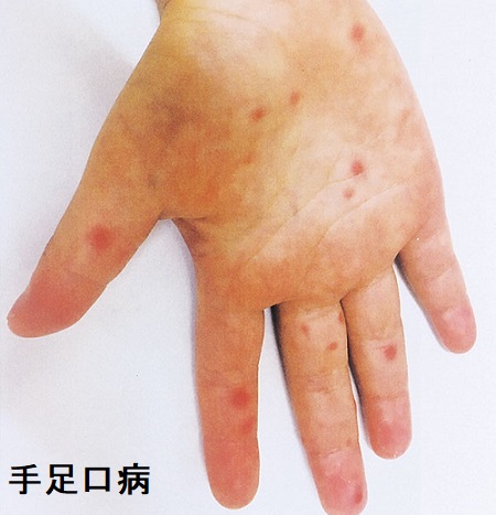手足口病 手足口病