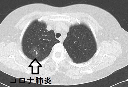 コロナ肺炎 CT画像 コロナ肺炎 CT画像