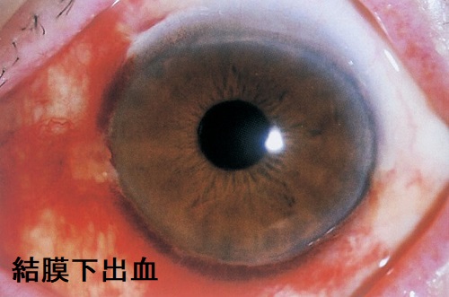 結膜下出血 結膜下出血