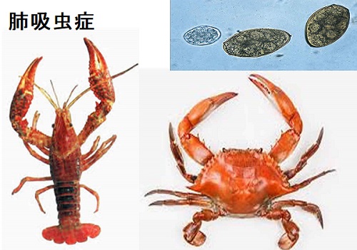 肺吸虫症 肺吸虫症