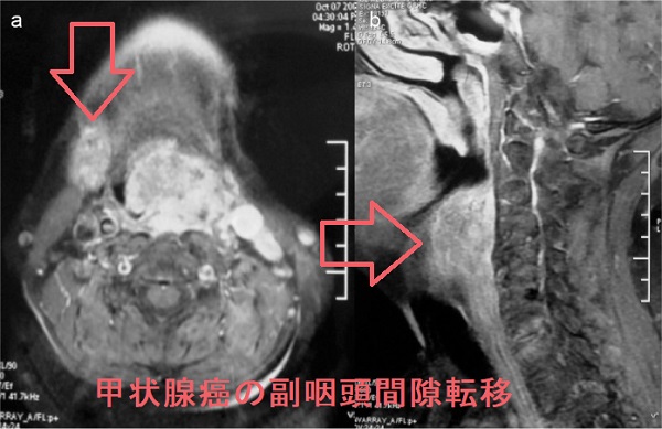 甲状腺癌の副咽頭間隙転移 甲状腺癌の副咽頭間隙転移