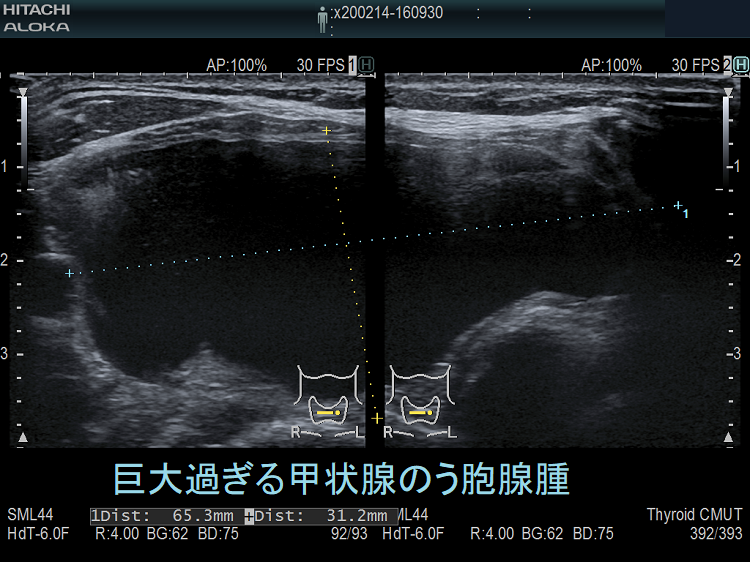 巨大過ぎる甲状腺のう胞腺腫 超音波(エコー)画像(水平断) 巨大過ぎる甲状腺のう胞腺腫 超音波(エコー)画像(水平断)