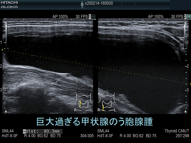 巨大過ぎる甲状腺のう胞腺腫 超音波(エコー)画像(垂直断) 巨大過ぎる甲状腺のう胞腺腫 超音波(エコー)画像(垂直断)